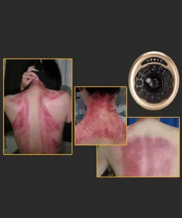 Аппарат вакуумного массажа с инфракрасным прогревом SHUXING SX-866B фото в интернет магазине | zdorov.by