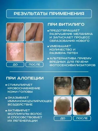 Лампа Аведерма от псориаза, витилиго и алопеции фото в интернет магазине | zdorov.by